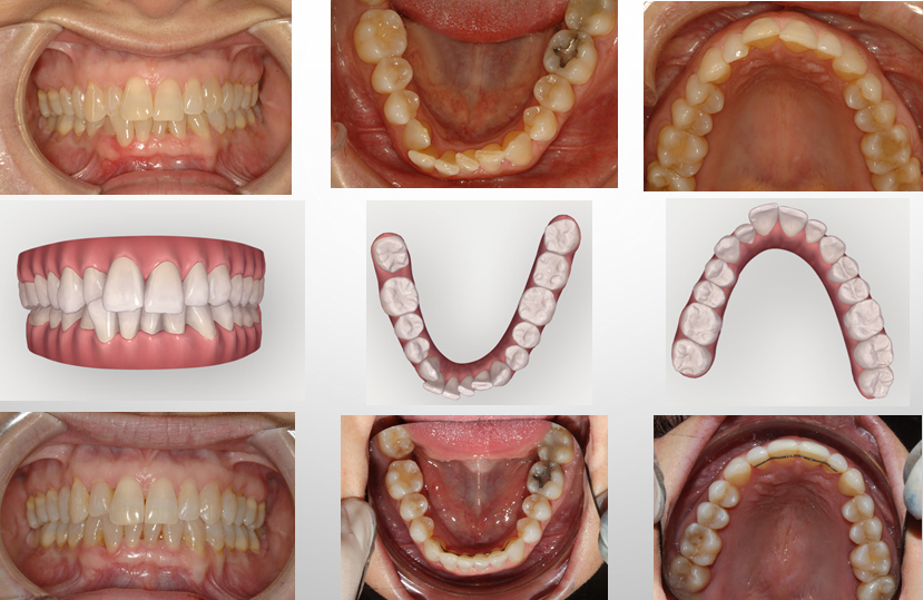 Tratamiento con ortodoncia Invisalign